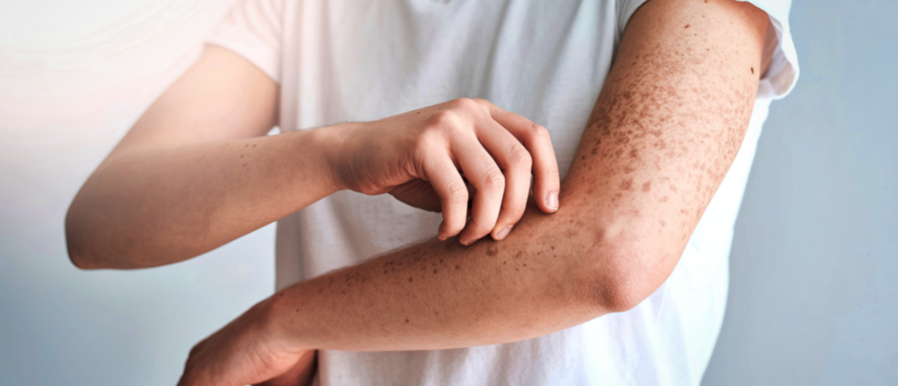 Person scratching skin due to itching and red rashes on arm