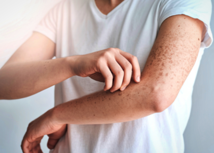 Person scratching skin due to itching and red rashes on arm